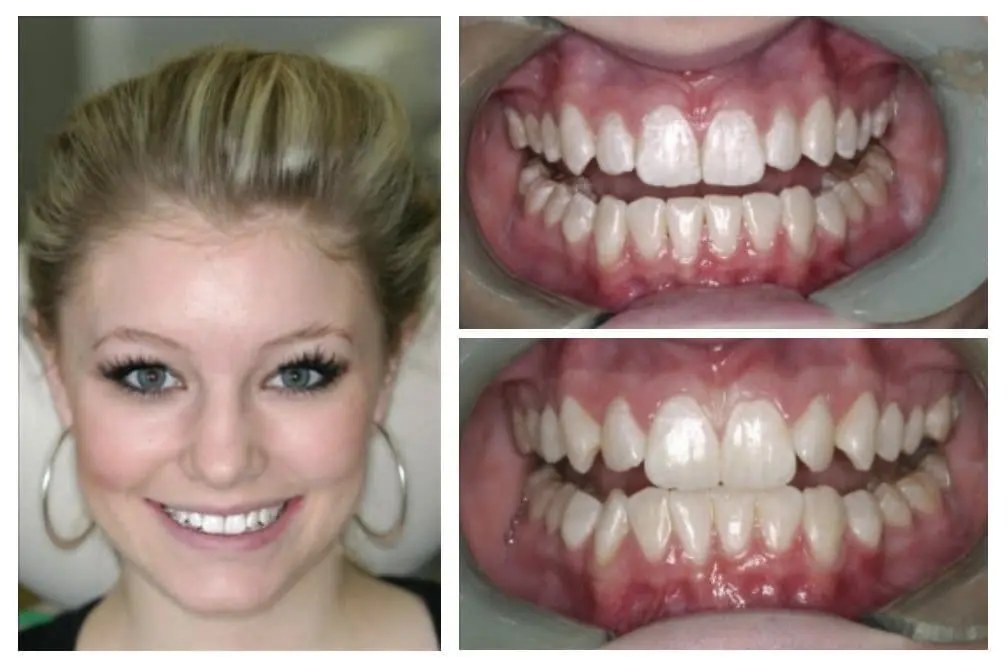Invisalign before and after — Kelsey's rotated teeth aligned over 9 months