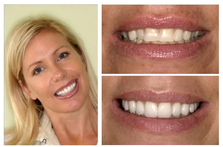 Smile design before and after — ten new porcelain veneers