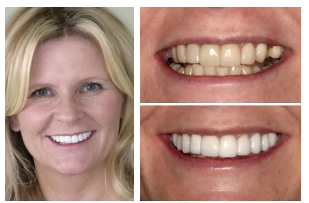 Veneers and bridge before and after — old veneers replaced