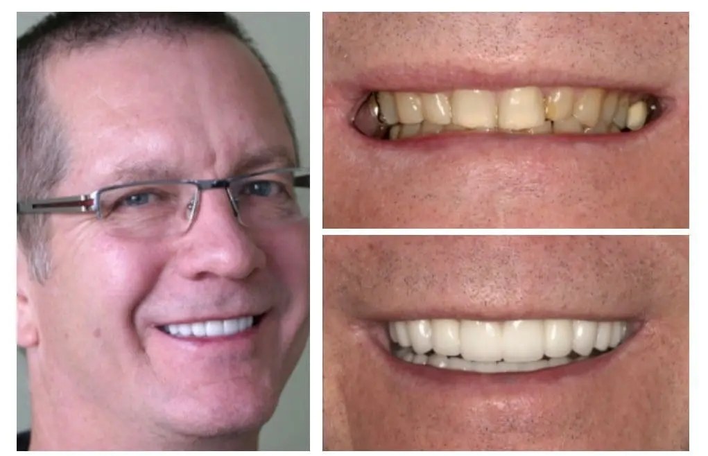 Smile restoration before and after — veneers, crowns, and implants