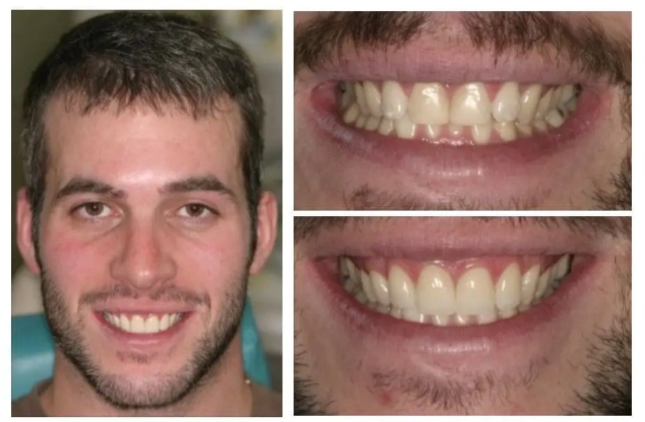 Porcelain veneers before and after — four veneers replacing old bonding